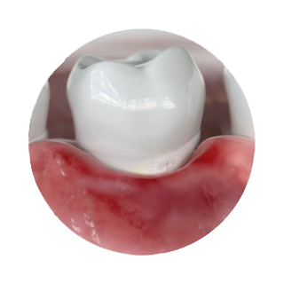 Denizli diş eti tedavisi