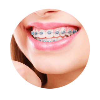 Denizli ortodonti diş teli şeffaf plak